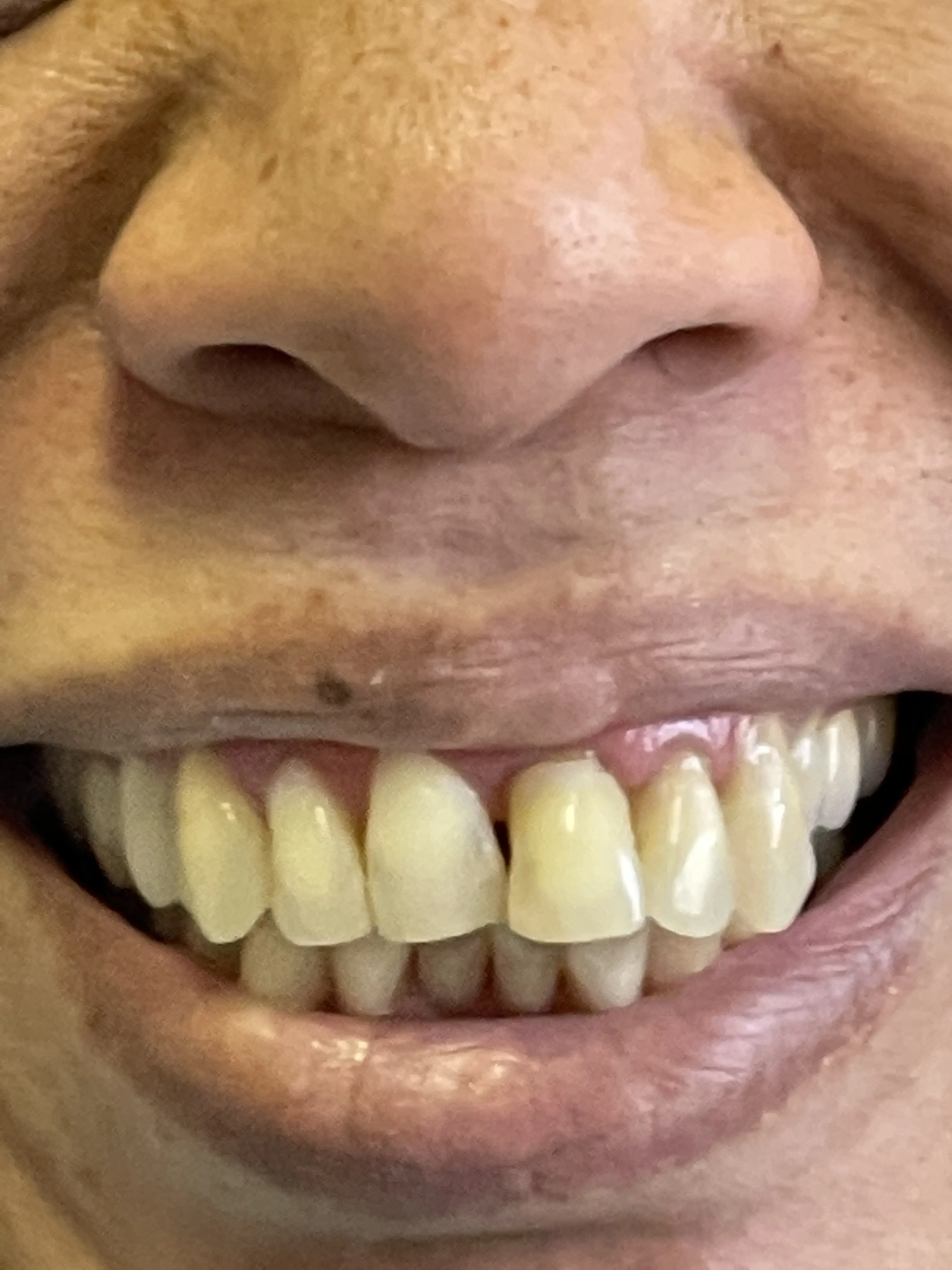 Close-up of the smile before treatment