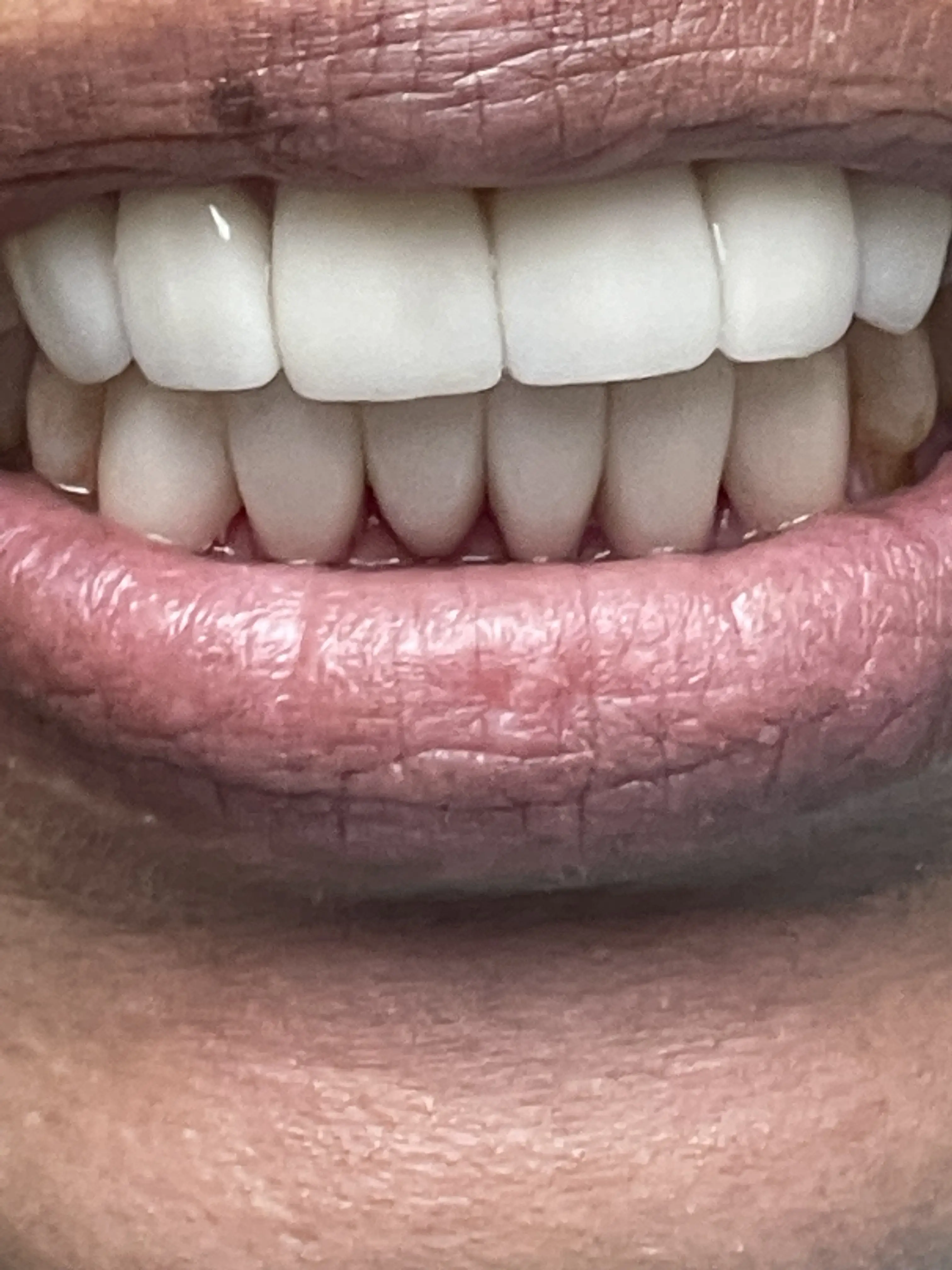 Close-up of the finished smile