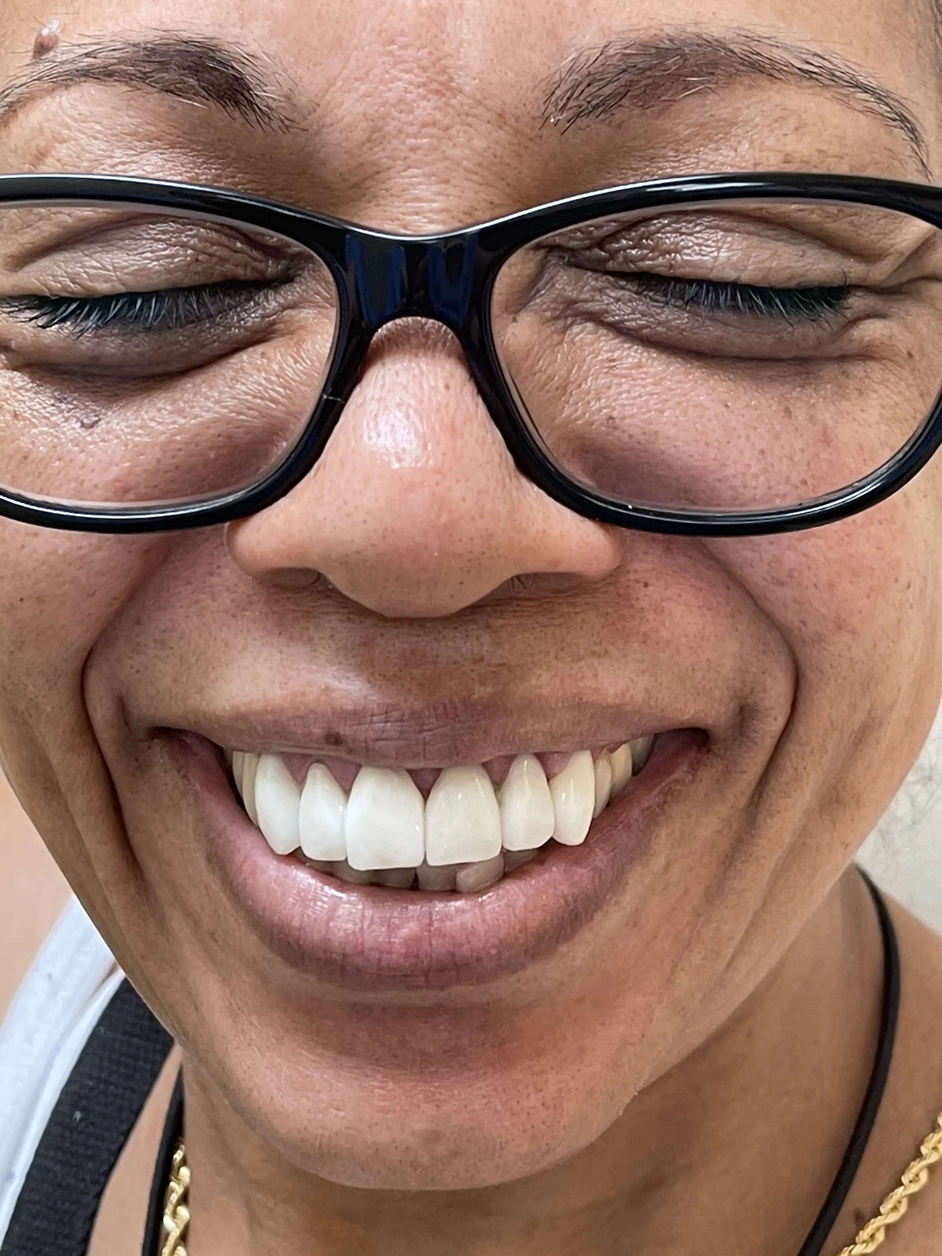 Patient smiling with temporary restorations